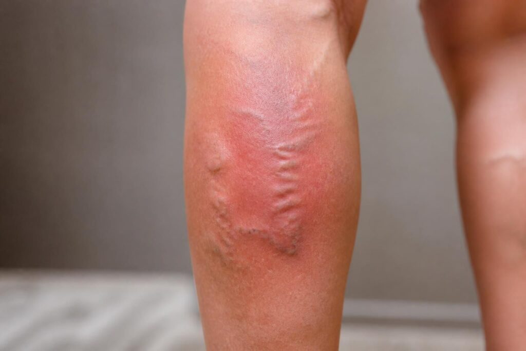 découvrez comment reconnaître les signes avant-coureurs de la phlébite pour agir rapidement et prévenir les complications. informez-vous sur les symptômes essentiels à surveiller.