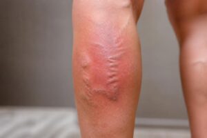 découvrez comment reconnaître les signes avant-coureurs de la phlébite pour agir rapidement et prévenir les complications. informez-vous sur les symptômes essentiels à surveiller.